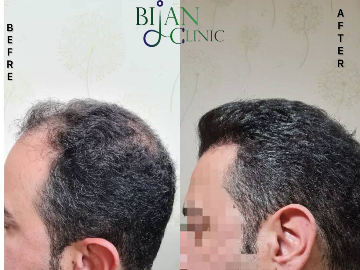 FUE hair transplant Sydney Bijan clinic