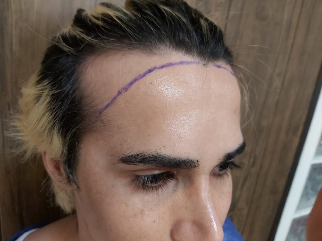 Female temple recession before FUE hairline transplant