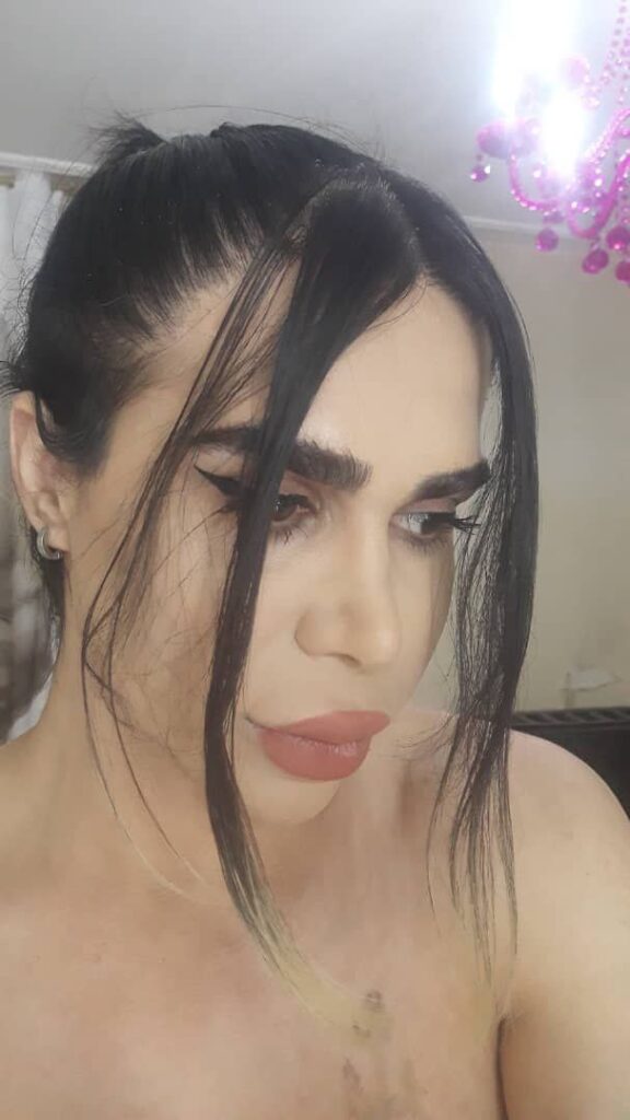 Developing female temple hair transplant result at confirmed follow-up