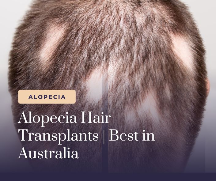 Alopecia hair treatment australia