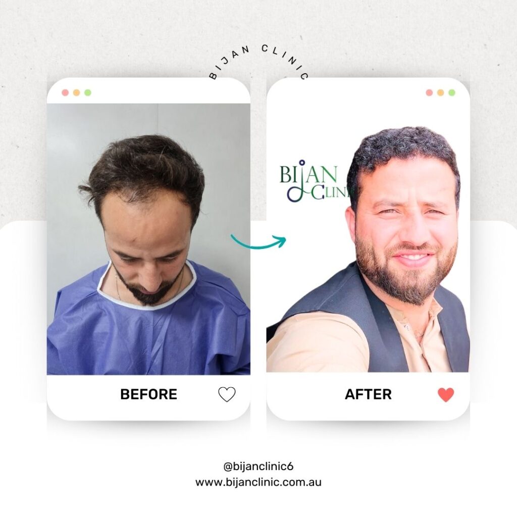 before after hair transplant