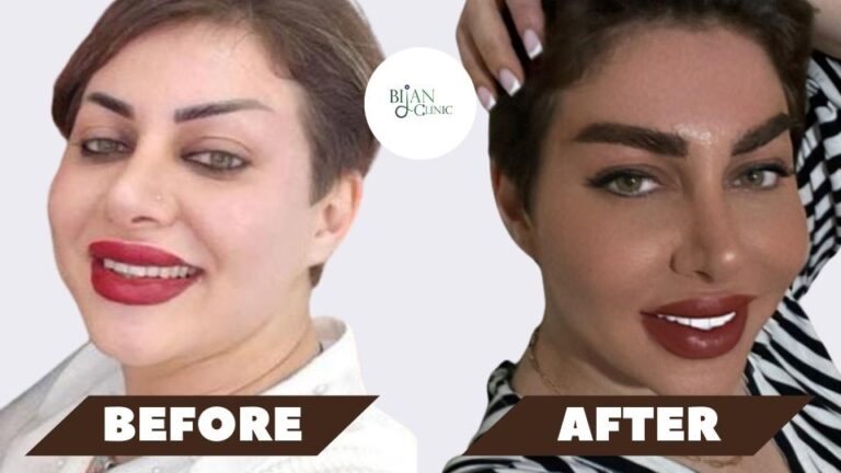 eyebrow transplant after 1 year