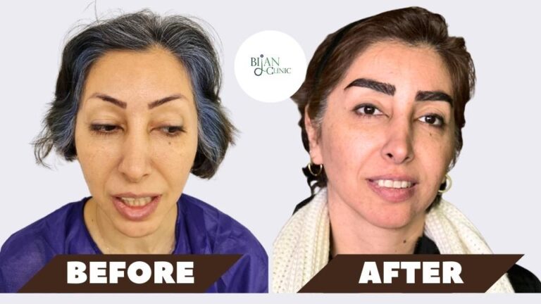 Natural Eyebrow Transplant Results – FUE & DHI – Sydney