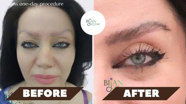 eyebrow transplant after 1 month