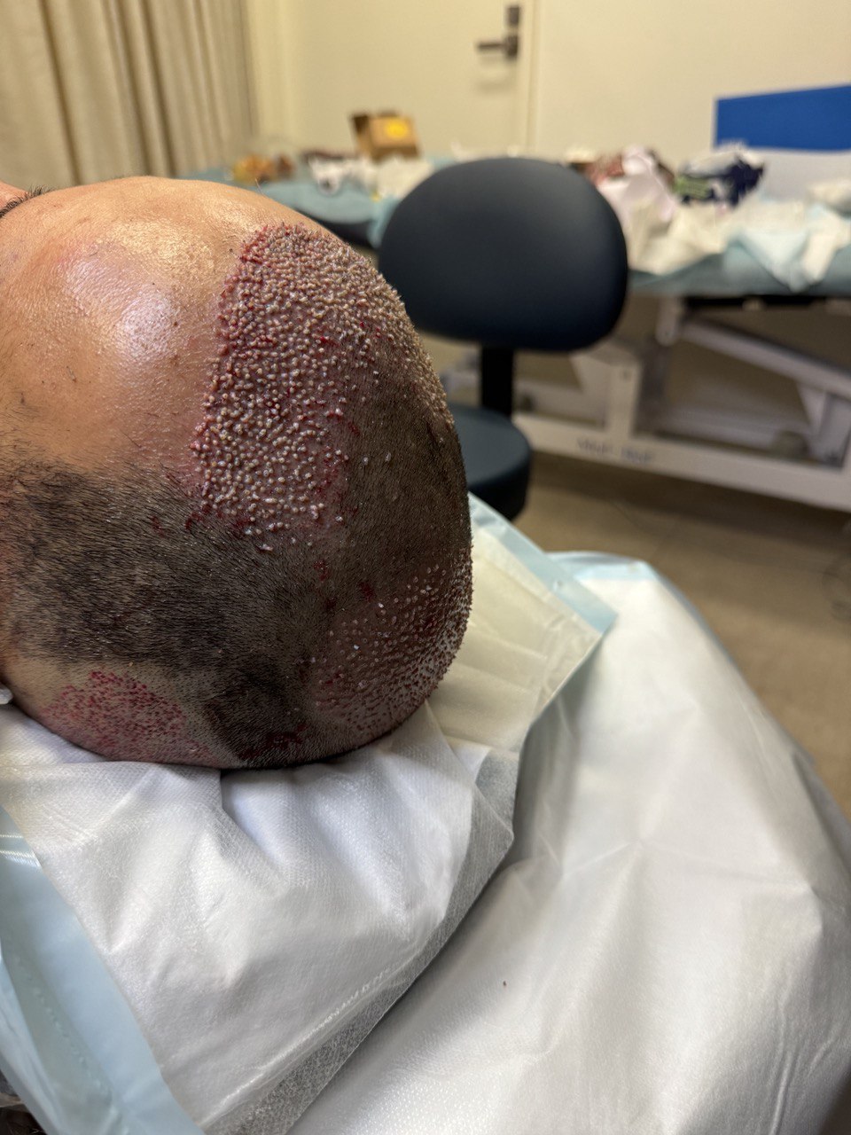 Hair transplant donor area assessment at Bijan Clinic Sydney