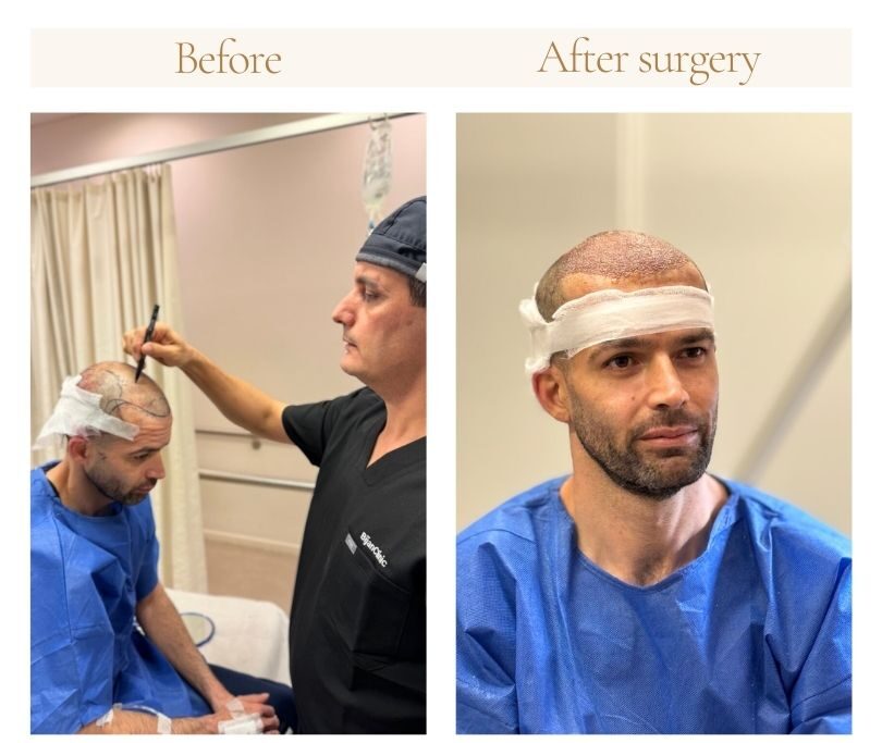 Doctor designing hairline on patient during consultation at Bijan Clinic hair transplant Sydney