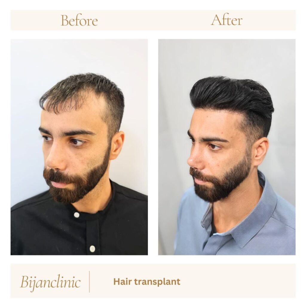 5000 grafts hair transplant | Bijan Clinic