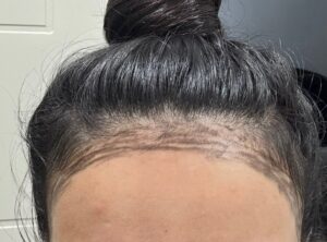 Front view before female FUE hairline lowering for a naturally high forehead