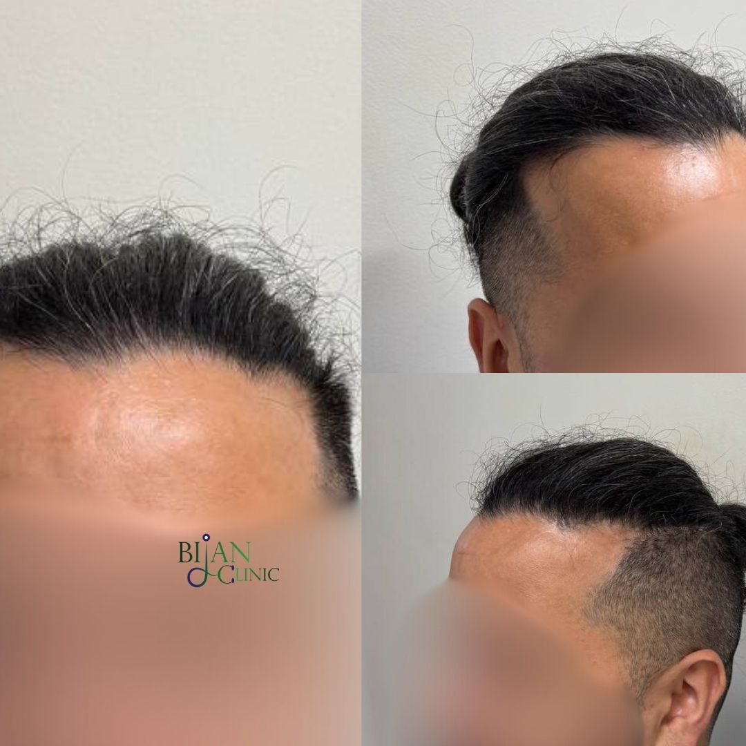Natural hairline design FUE hair transplant — Dr. Bijan Shabani Sydney