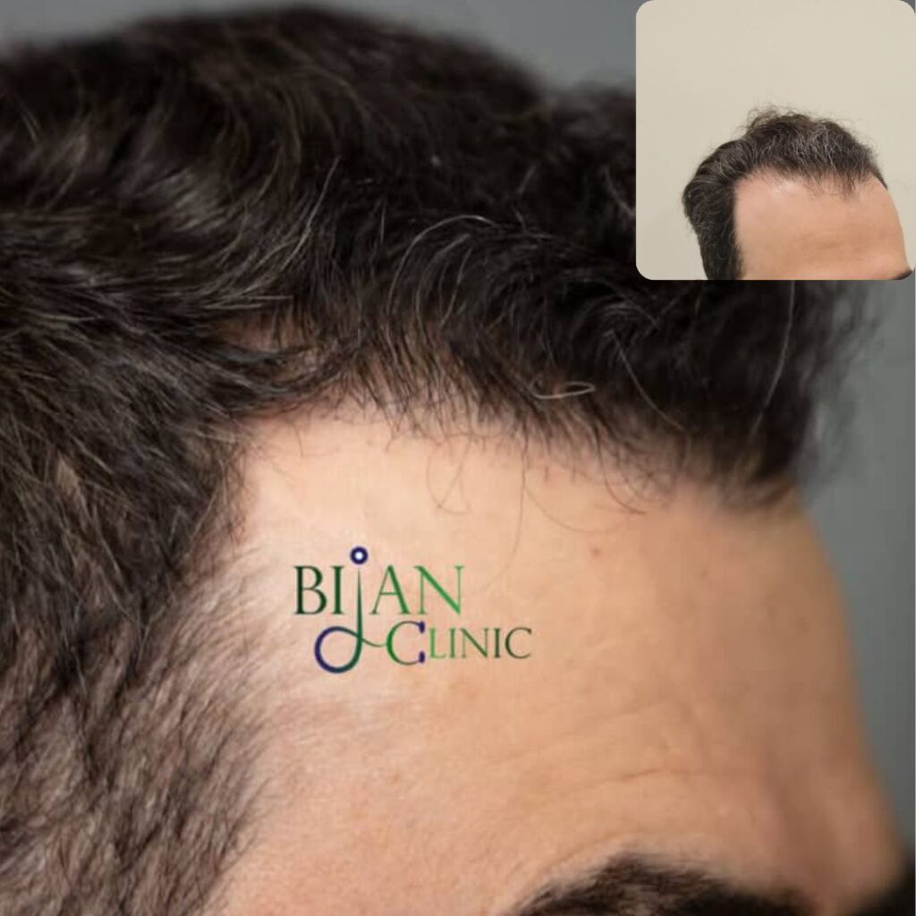 FUE hairline lowering design for a patient with a high forehead at Bijan Clinic Sydney