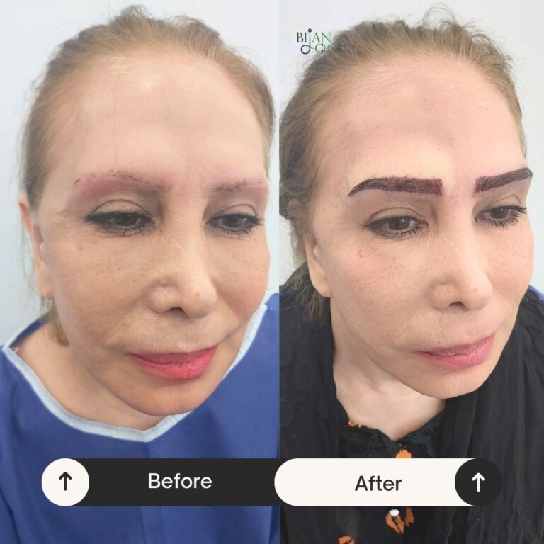 Eyebrow transplant Sydney