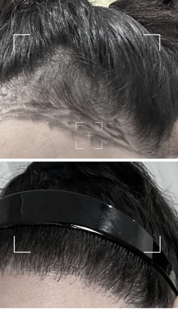 Best sleeping position after a hair transplant