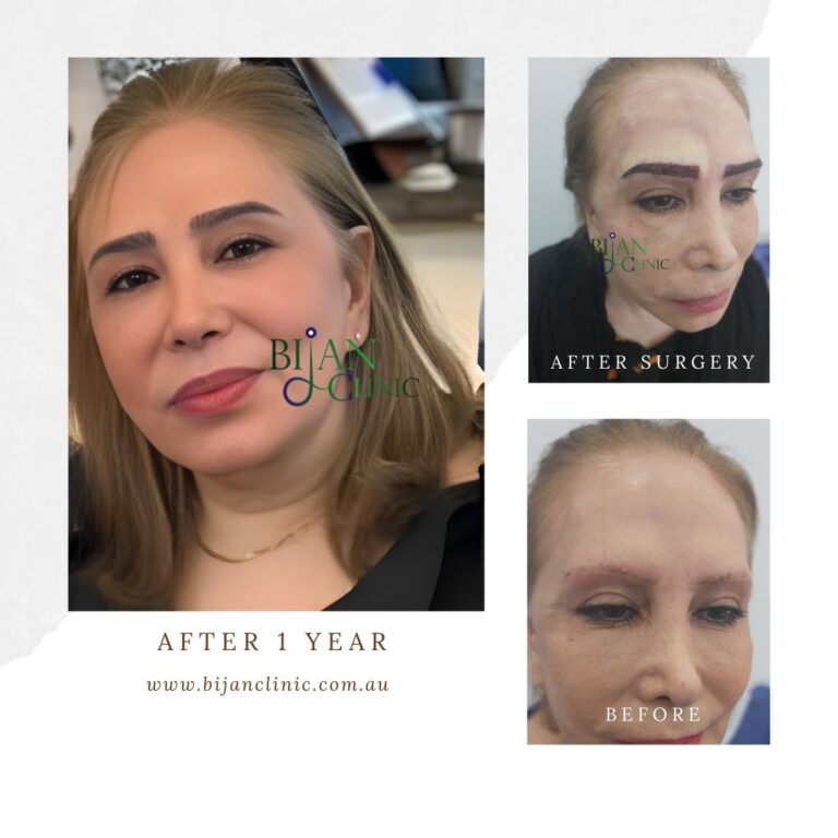 eyebrow transplant vs microblading