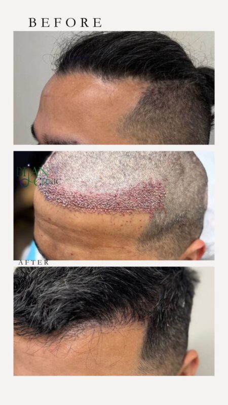 Before and after hair transplant showing natural irregular hairline design at Bijan Clinic Sydney