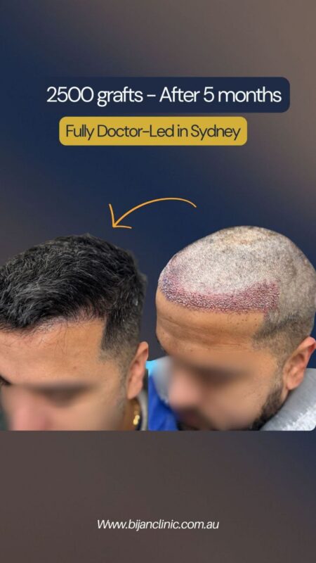 Before 2500 grafts hair transplant in Sydney – receding hairline
