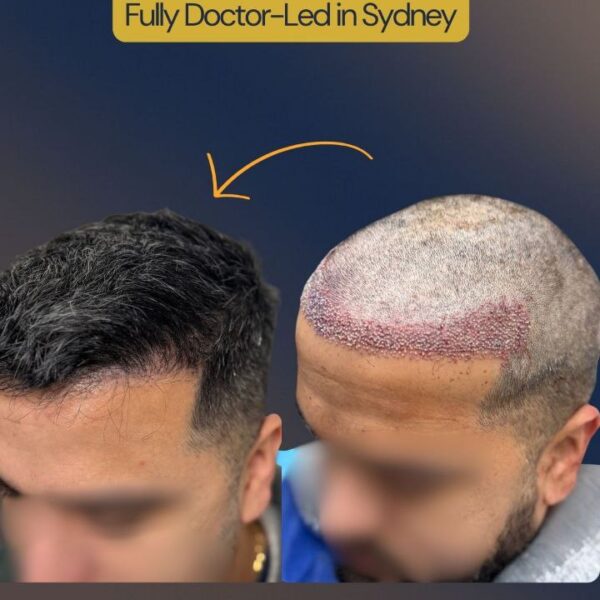 Before 2500 grafts hair transplant in Sydney – receding hairline
