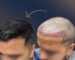 Before 2500 grafts hair transplant in Sydney – receding hairline