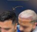 Before 2500 grafts hair transplant in Sydney – receding hairline