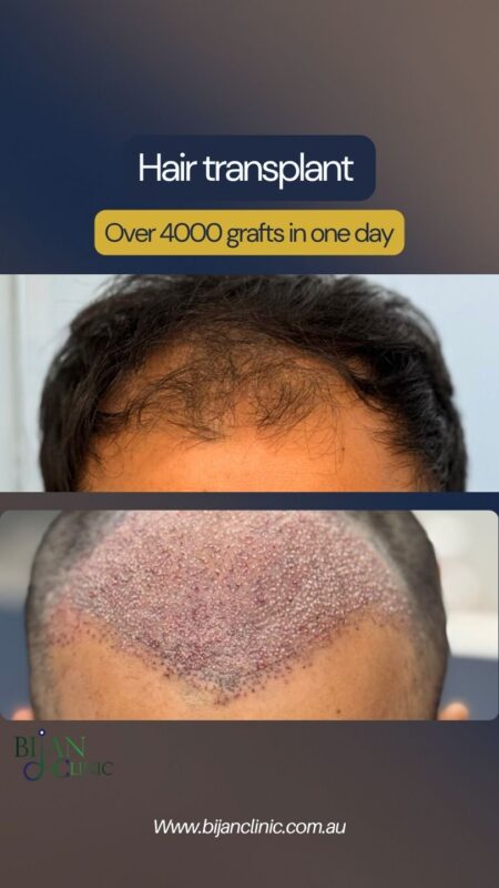 Why Christmas holidays are a great time for hair transplant recovery