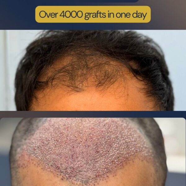 Why Christmas holidays are a great time for hair transplant recovery