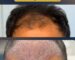 Why Christmas holidays are a great time for hair transplant recovery
