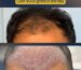 Why Christmas holidays are a great time for hair transplant recovery