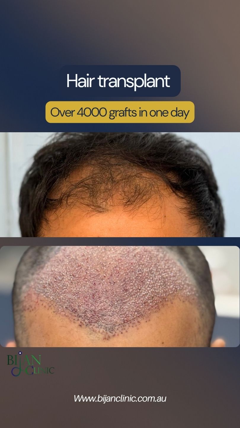 Why Christmas holidays are a great time for hair transplant recovery
