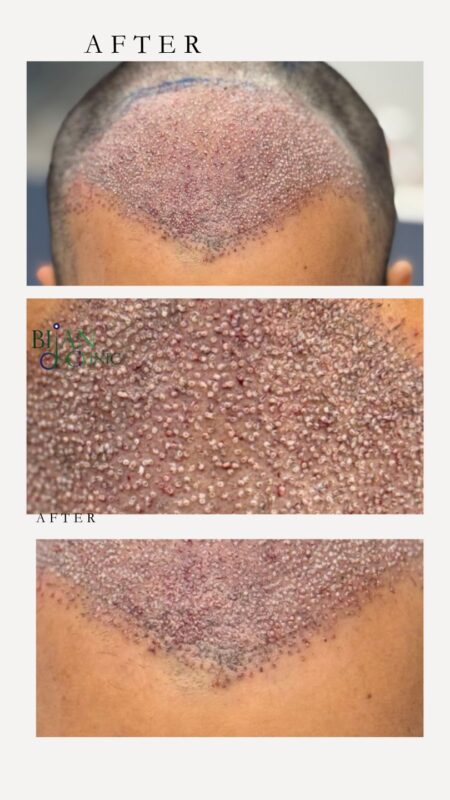 Hair transplant recovery timeline from week 1 to 12 months