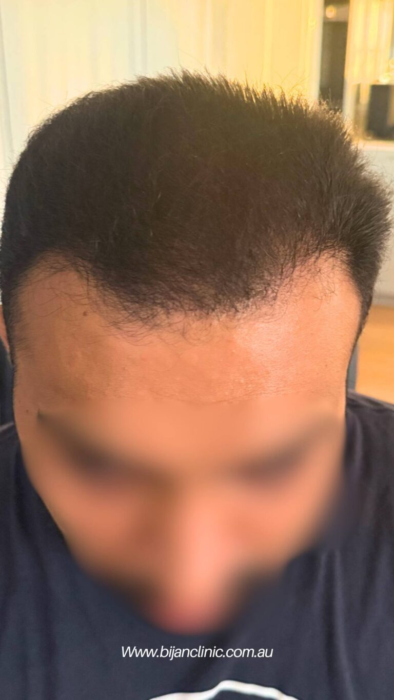 4500 grafts after hair transplant