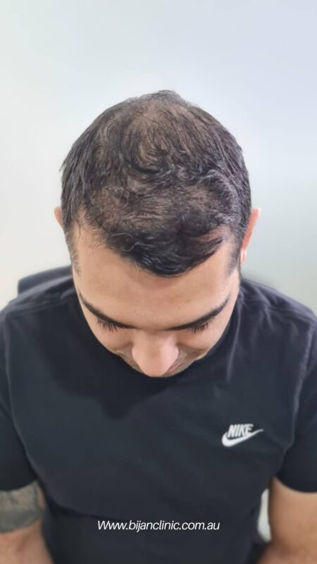 Bijanclinic before and after hair transplant