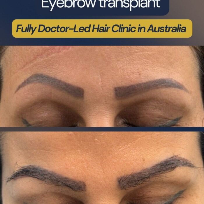 Custom eyebrow transplant correcting asymmetry caused by old eyebrow tattoo