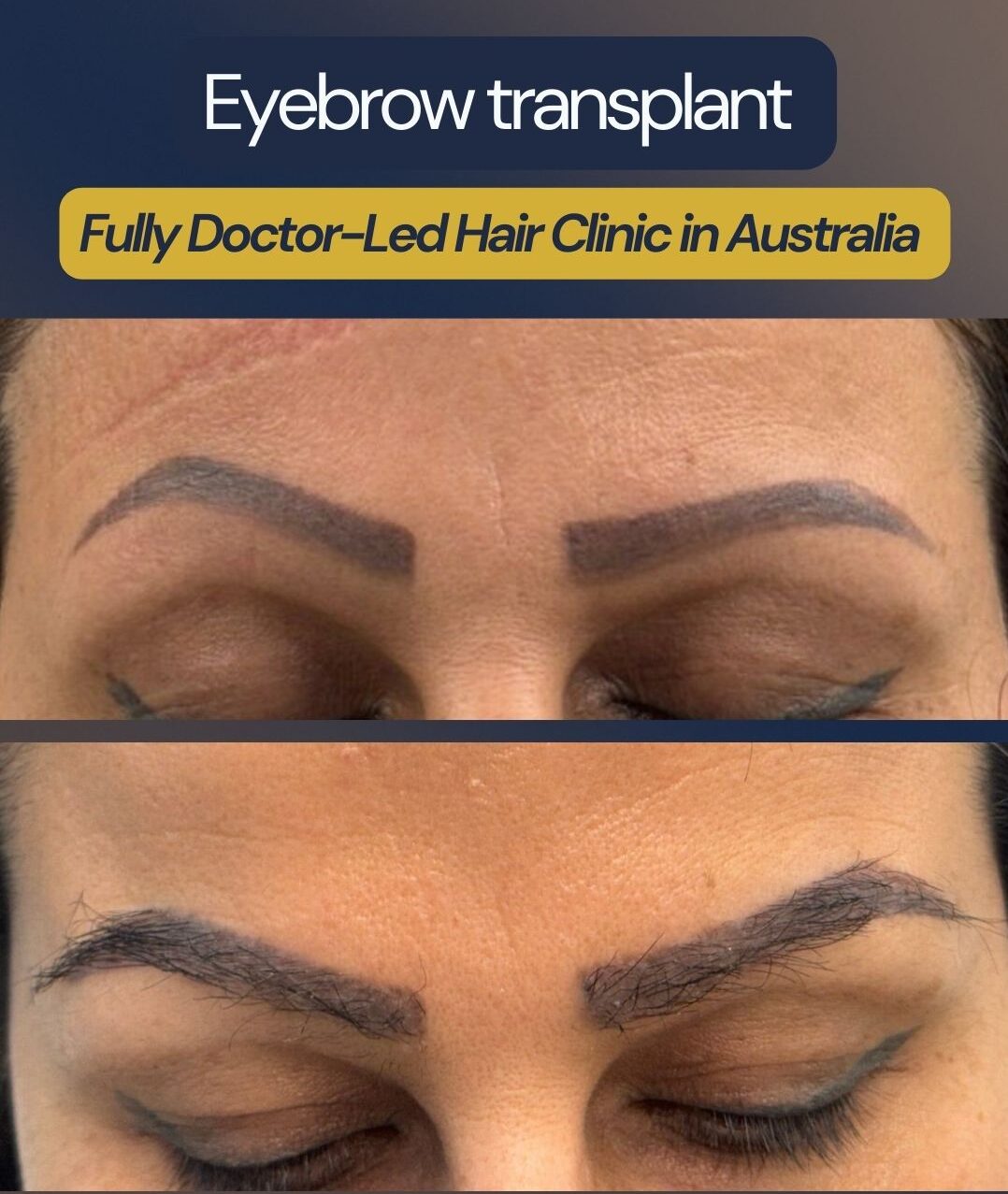 Custom eyebrow transplant correcting asymmetry caused by old eyebrow tattoo