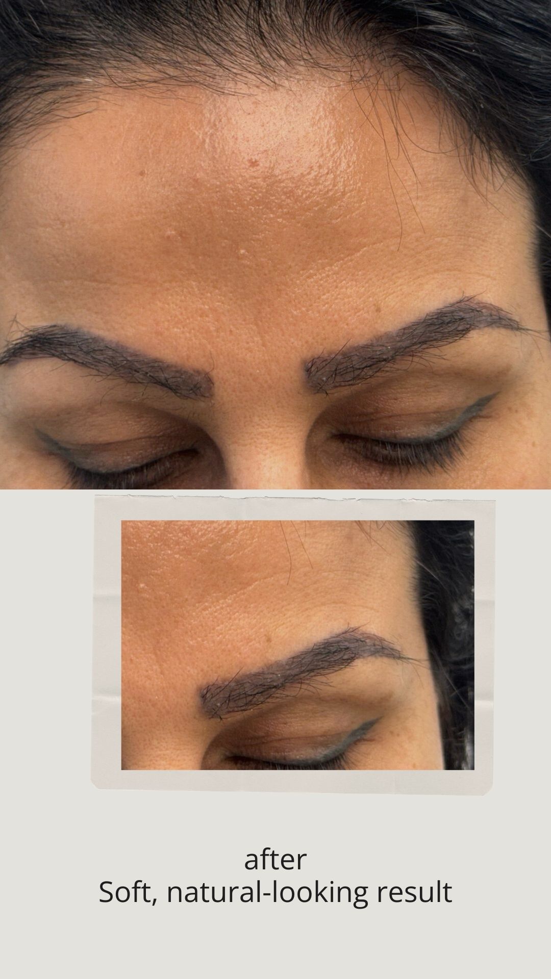after eyebrow transplant surgery