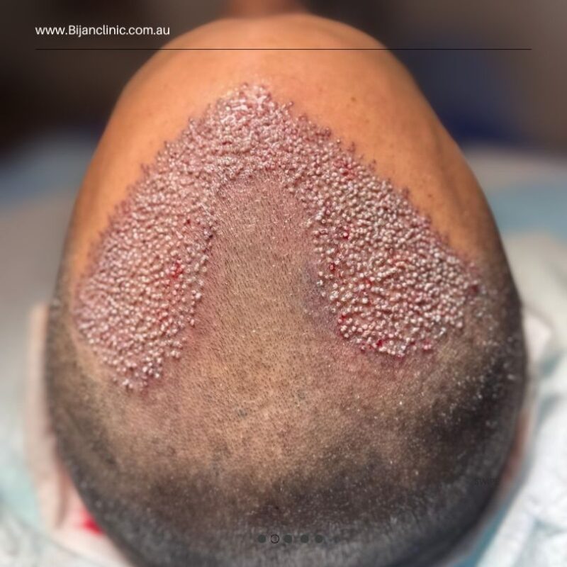FUE micro punch extraction — Bijan Clinic Auburn Sydney