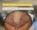 Natural hairline design drawn on patient forehead before hair transplant procedure at Bijan Clinic Sydney