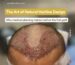 Natural hairline design drawn on patient forehead before hair transplant procedure at Bijan Clinic Sydney