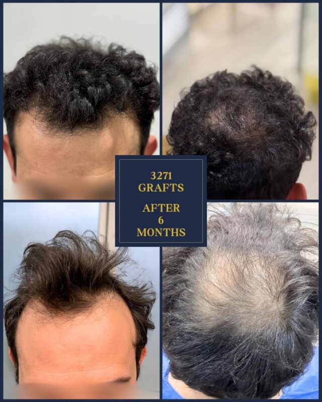 3271 graft hair transplant before and 6 months after showing frontal and crown improvement