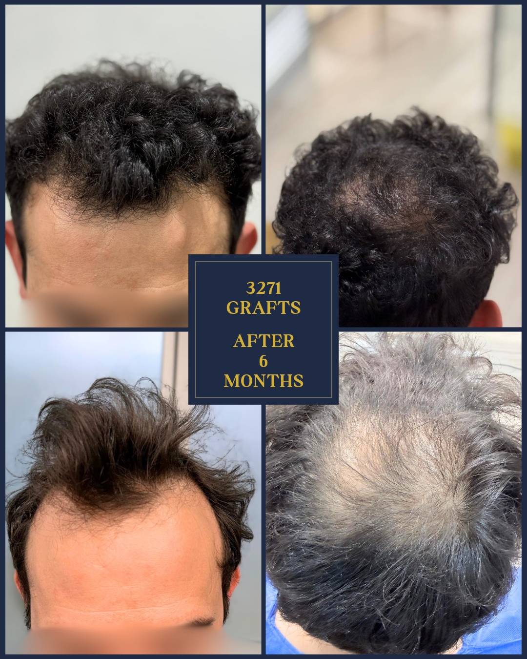 3271 graft hair transplant before and 6 months after showing frontal and crown improvement