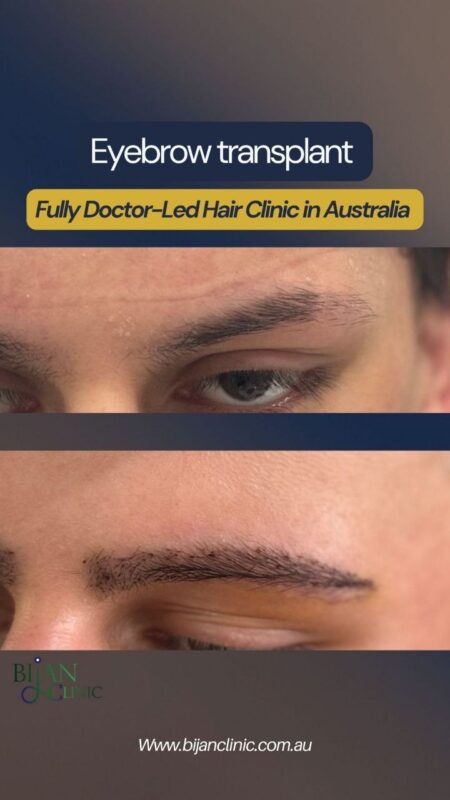 Men Eyebrow transplant in Sydeny