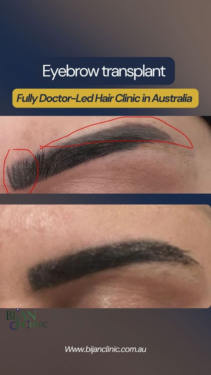 eyebrow transplant Australia