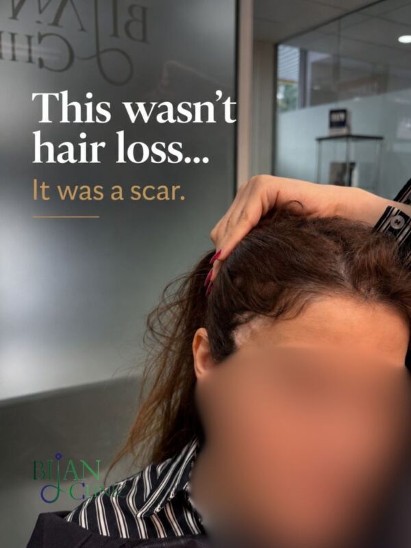 this was not a simple hair loss hair transplant for eyebrow lift scar , FUE hair transplant for scar