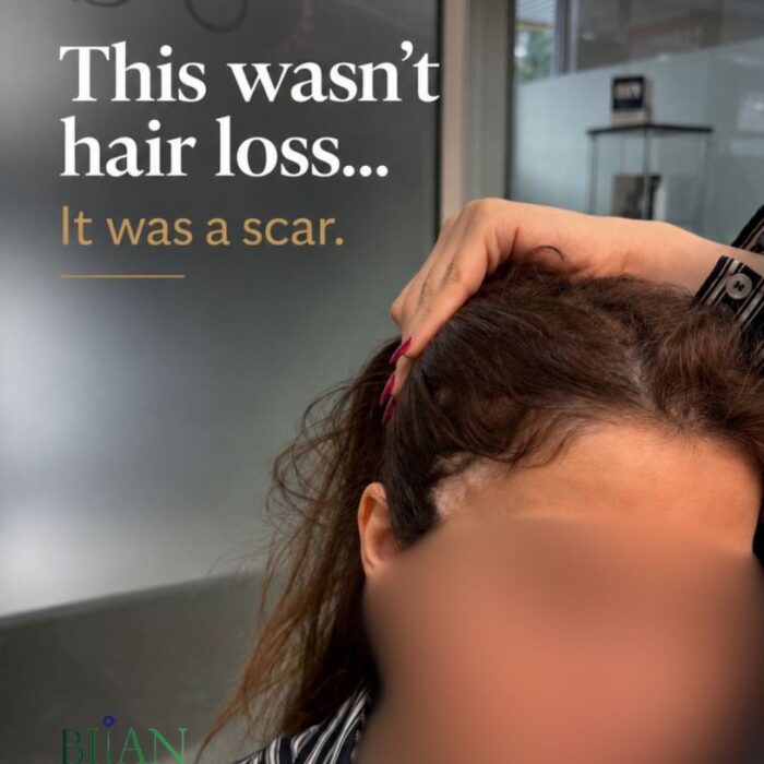 this was not a simple hair loss hair transplant for eyebrow lift scar , FUE hair transplant for scar