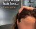 this was not a simple hair loss hair transplant for eyebrow lift scar , FUE hair transplant for scar
