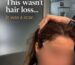this was not a simple hair loss hair transplant for eyebrow lift scar , FUE hair transplant for scar