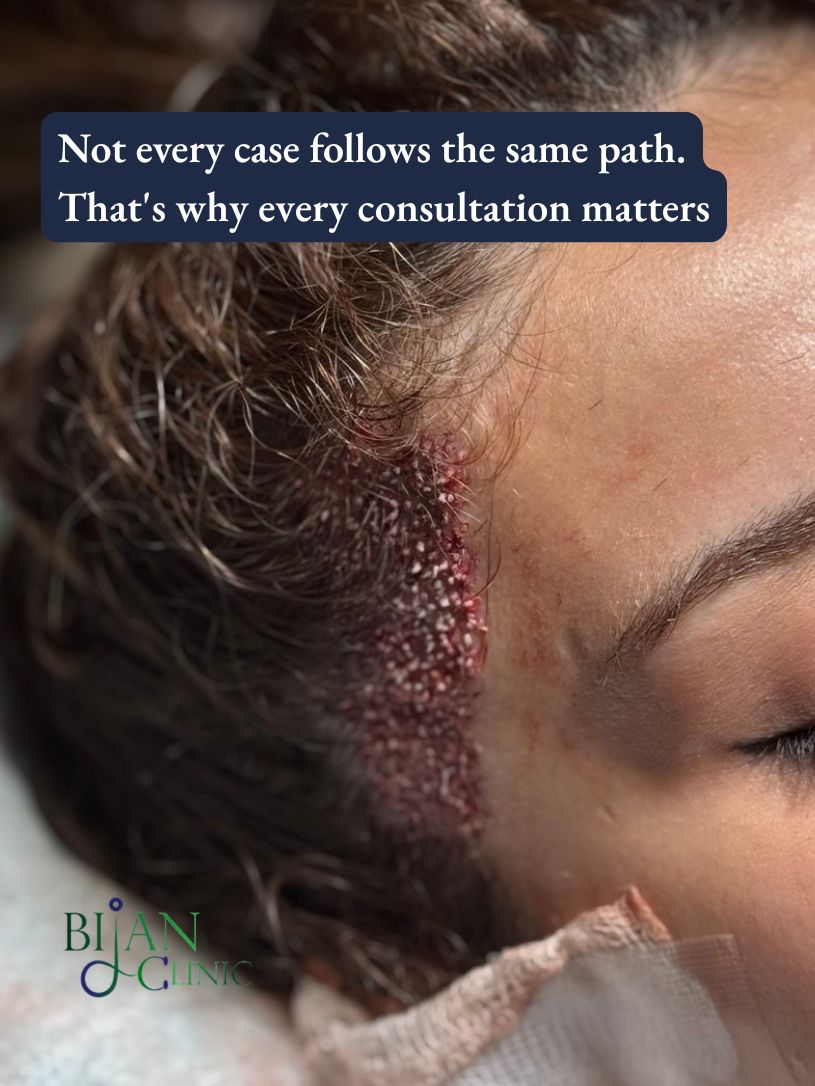 The immediate post-operative photographs show the recipient area shortly after the full FUE procedure.