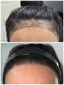 Six-month developing result after female hairline lowering with FUE