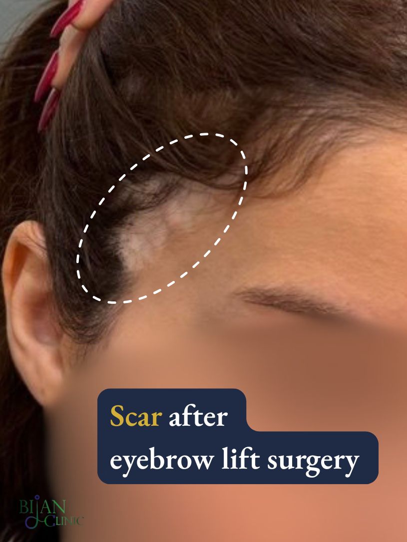 Hairline scar after previous eyebrow lift surgery before FUE treatment