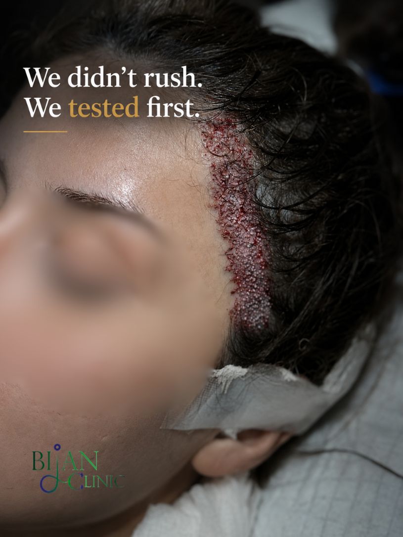 Immediate result after full FUE hair transplant into eyebrow lift scar