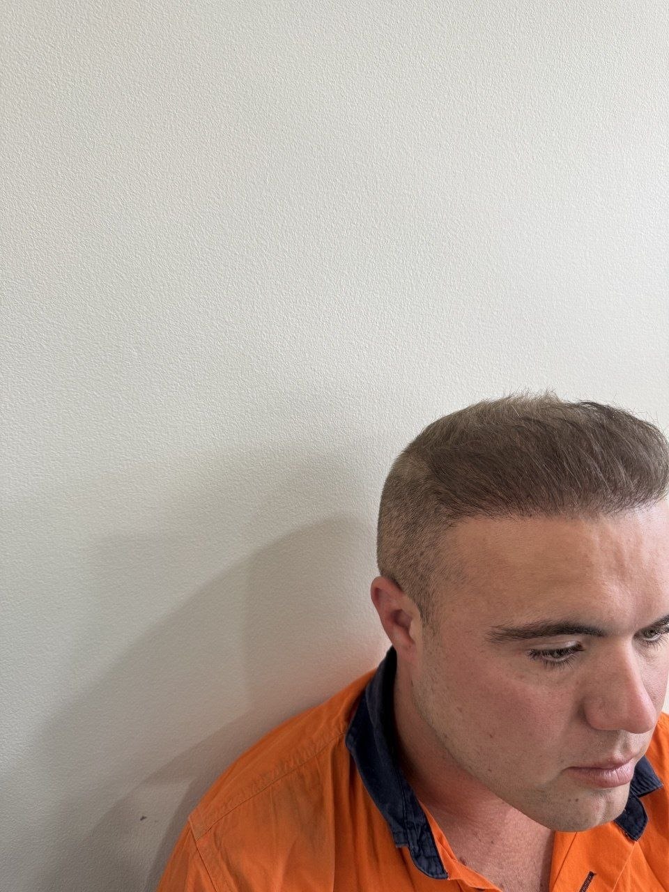 hair transplant cost