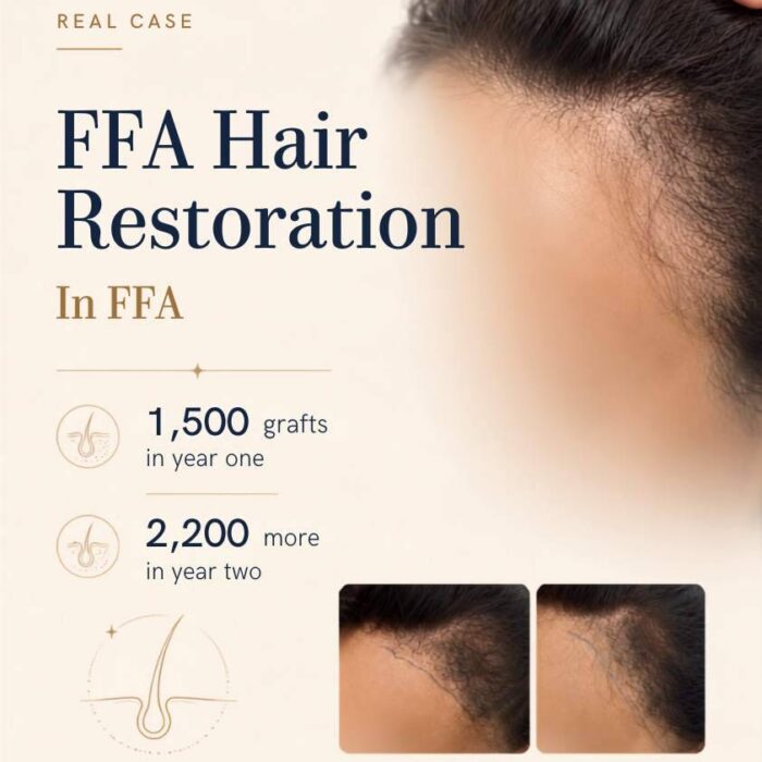 Frontal fibrosing alopecia hair transplant